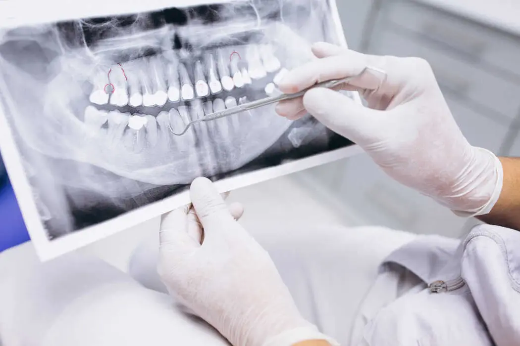 Czy warto zdecydować się na implanty zębów